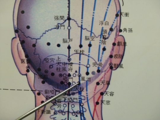 ヘッド置鍼 - 名古屋駅近くで肩こり・五十肩のお悩みは整体